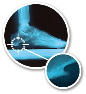 Plantar Fasciitis Illustration